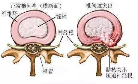 穿破石治疗腰椎间盘突出，药用法与效果解析