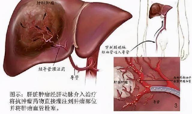 肝癌晚期介入转化治疗的曙光