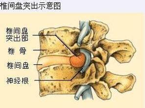 穿破石外敷治疗腰椎间盘突出，自然疗法的有效性探索